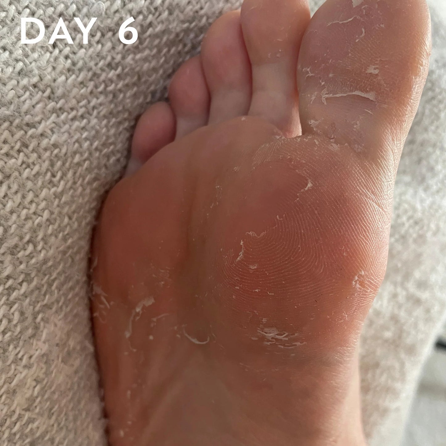 FOOT PEEL Professional Foot Treatment