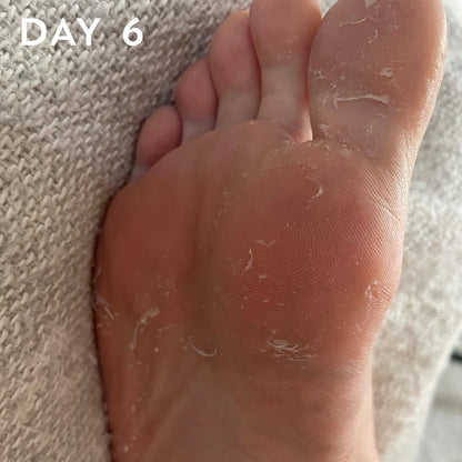 FOOT PEEL Professional Foot Treatment